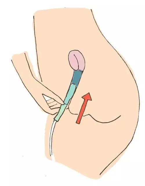 为了处理“大姨妈”,她们把杯子放进了身体里
