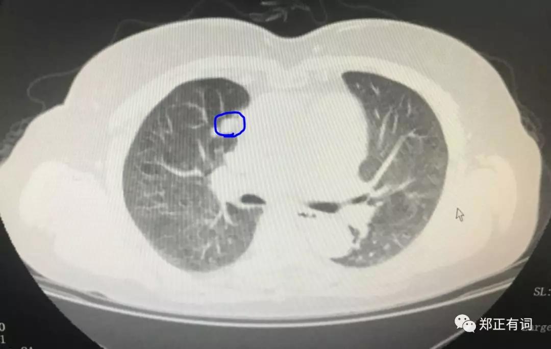 心肺功能特别差能动肺手术吗,肺癌想做手术呼吸功能差怎么办