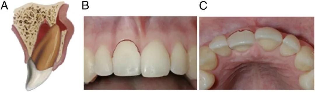 宝宝磕到牙会伤到神经吗,宝宝磕掉乳牙还能再长吗