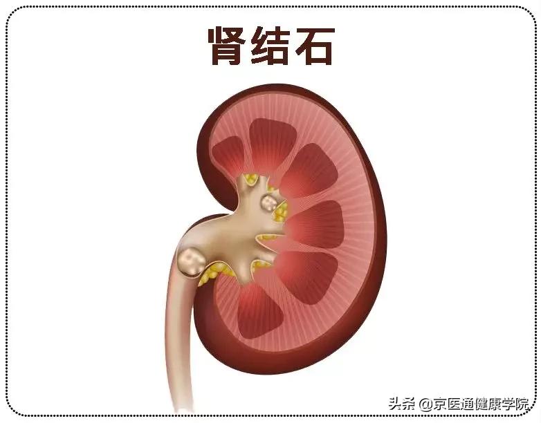 肾绞痛跟生孩子哪个痛,肾绞痛碎石怎么操作