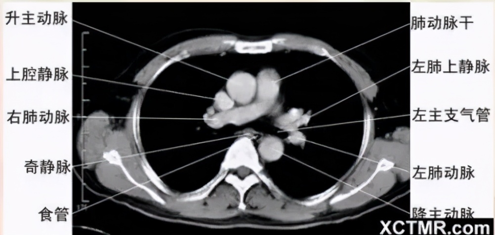 女性盆腔ct断层解剖结构图,女性盆腔脏器ct解剖