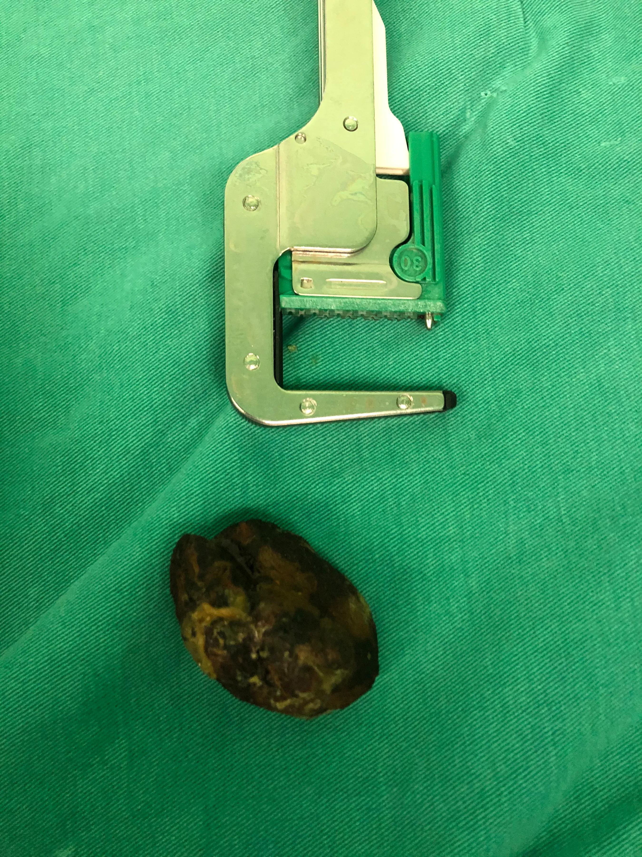 老年人肠梗阻会要命吗,老年人结肠癌伴随肠梗阻怎么办