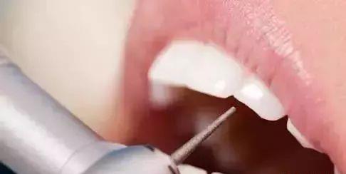 补牙视频过程医生视角,补牙真实全过程