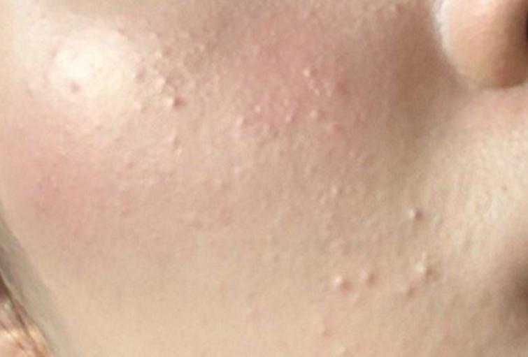 脸上长闭口怎么快速消除学生,脸上长闭口怎么办用什么方法消除