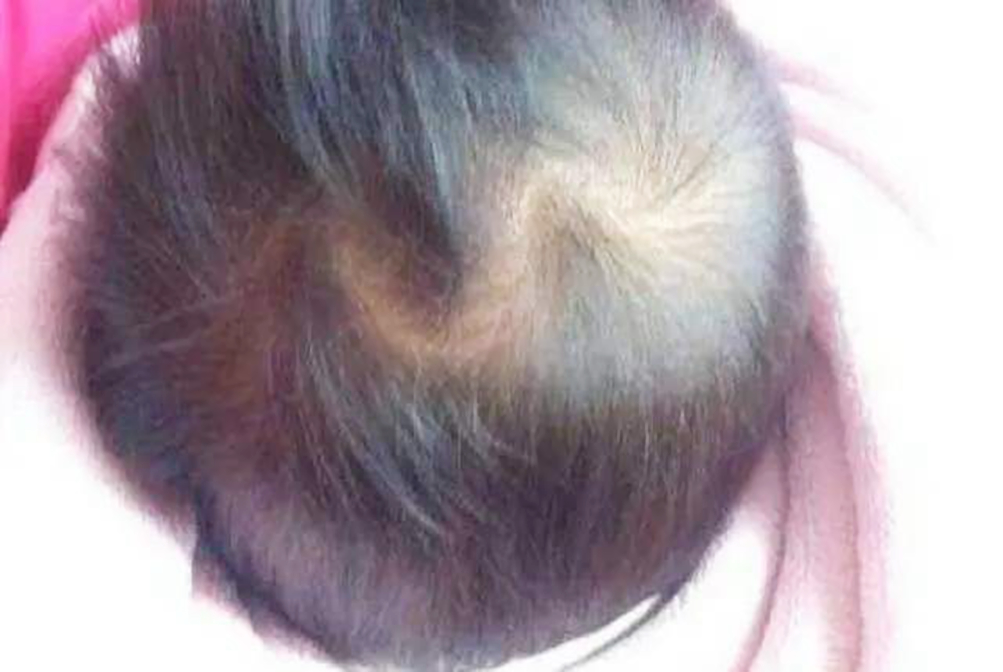 孩子头旋是逆时针智商低吗,宝宝的头旋偏右