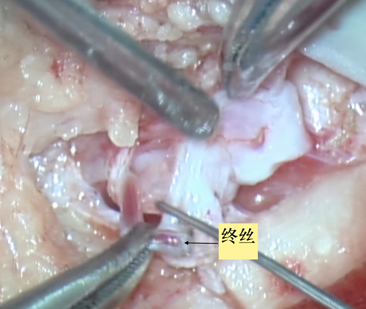 脊柱裂脊髓栓系手术恢复过程,脊柱裂与脊髓脊膜膨出的区别