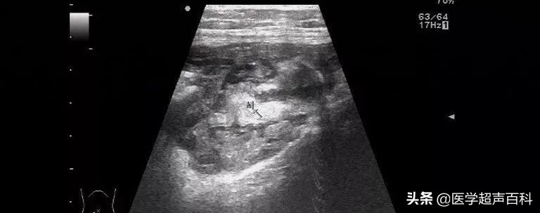 阑尾粘液性肿瘤低度恶性怎么处理,恶性阑尾黏液肿瘤是癌症吗