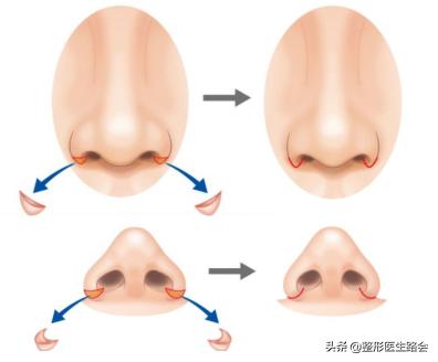 鼻翼缩小和鼻翼缩小之后的对比,超有效的缩小鼻翼的方法