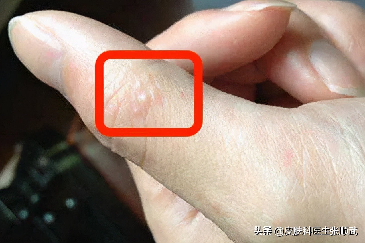 手上小水泡汗疱疹,脚上手上起小水泡很痒可以根治吗
