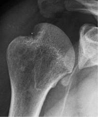 肩关节评定量表cms,肩关节功能评估法cms