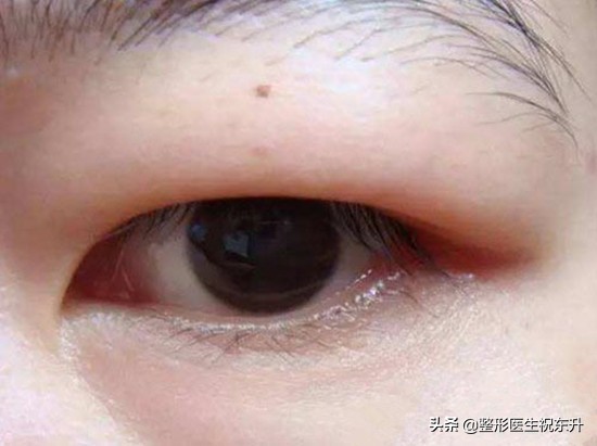 肿眼泡，上睑皮肤略松弛，能割双眼皮矫正吗？