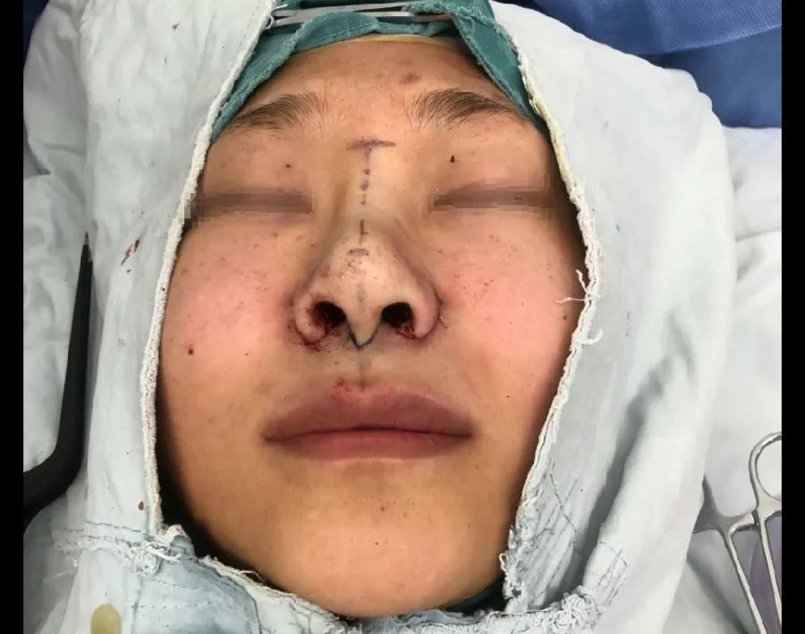 鼻翼缩小和鼻头缩小需要全麻吗,鼻头缩小和鼻翼缩小有什么区别