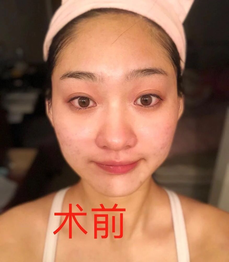 为什么做完鼻子看起来很假,鼻子做得很假是什么原因