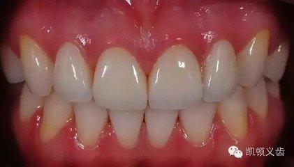 全瓷牙和烤瓷牙到底哪个好,烤瓷牙和全瓷牙优缺点及价格