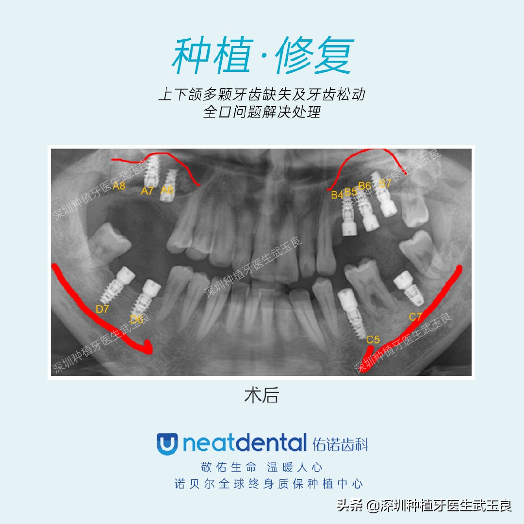 多颗牙齿缺失怎么修复全过程,多颗缺失牙修复案例