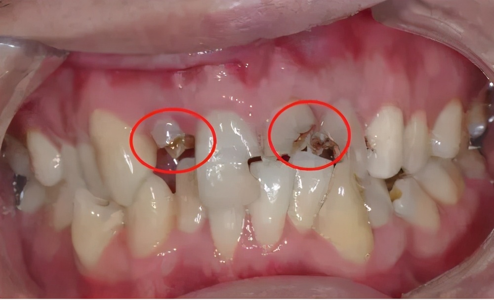 牙齿残根不疼不拔好吗,牙齿残根不疼