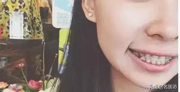 戴牙套2年不戴保持器反弹案例,戴牙套成功案例不戴保持器