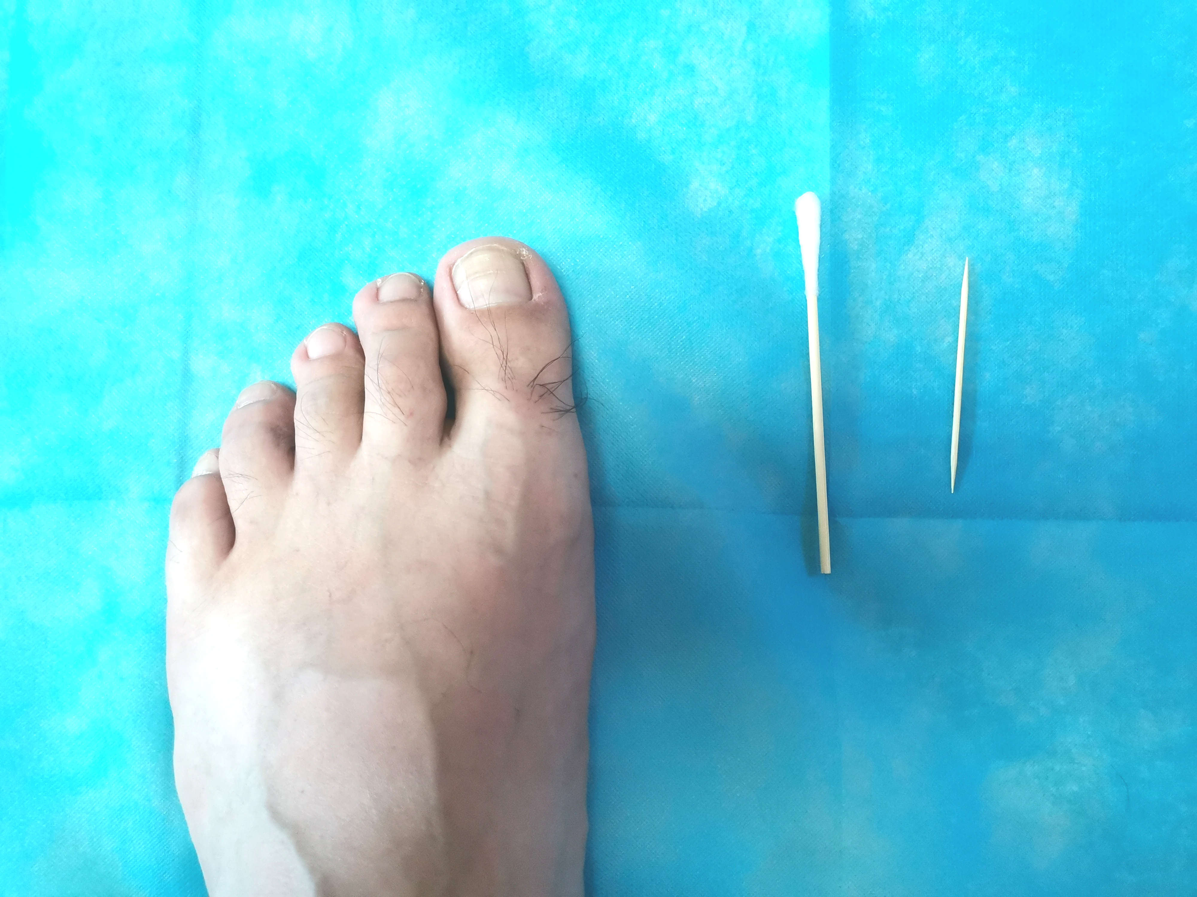 怎么用棉花治疗甲沟炎,严重甲沟炎用棉花塞有用吗