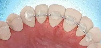 牙齿矫正完后不戴保持器会怎么样,牙齿矫正后不戴保持器会怎么样