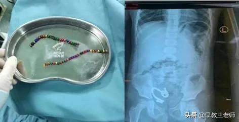 小孩误喝煤油后的现状,2岁男童误喝22倍退烧药被救