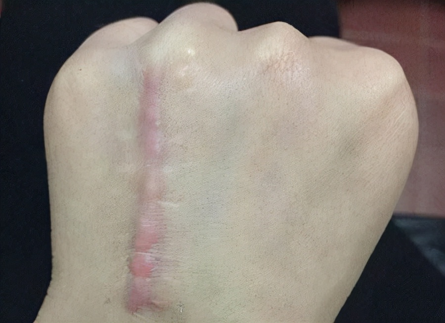 刀口增生了怎么消除？