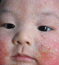 渗出性湿疹的症状和表现,小儿湿疹症状表现有哪些