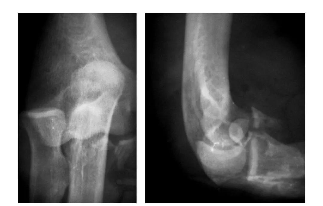 青少年肘部损伤最常见的是,肘部桡神经损伤的临床表现