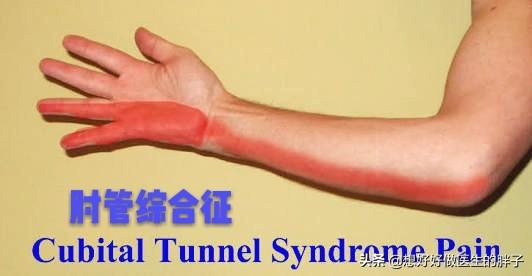 颈椎痛手臂麻有几种治疗方法,颈椎病手麻按脖子的哪一根筋