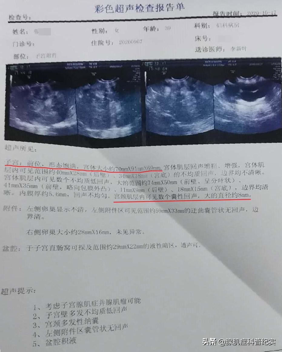 长了八个子宫肌瘤微创手术全过程,子宫粘膜下肌瘤的保宫手术