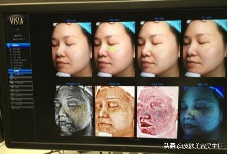 visia皮肤检测分高低吗,visia皮肤检测值多少是正常的
