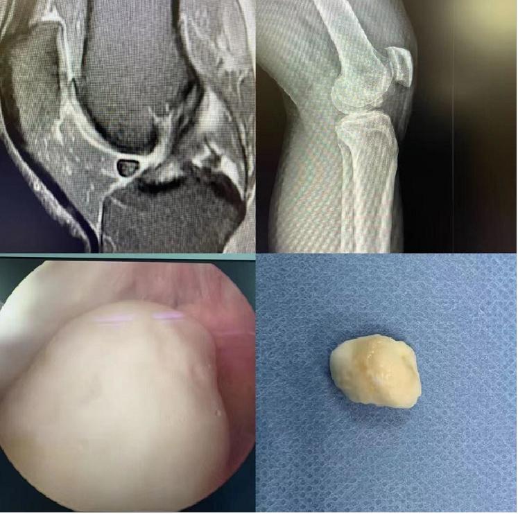 膝关节外侧有一个小包,膝关节里面有个小骨头是什么病