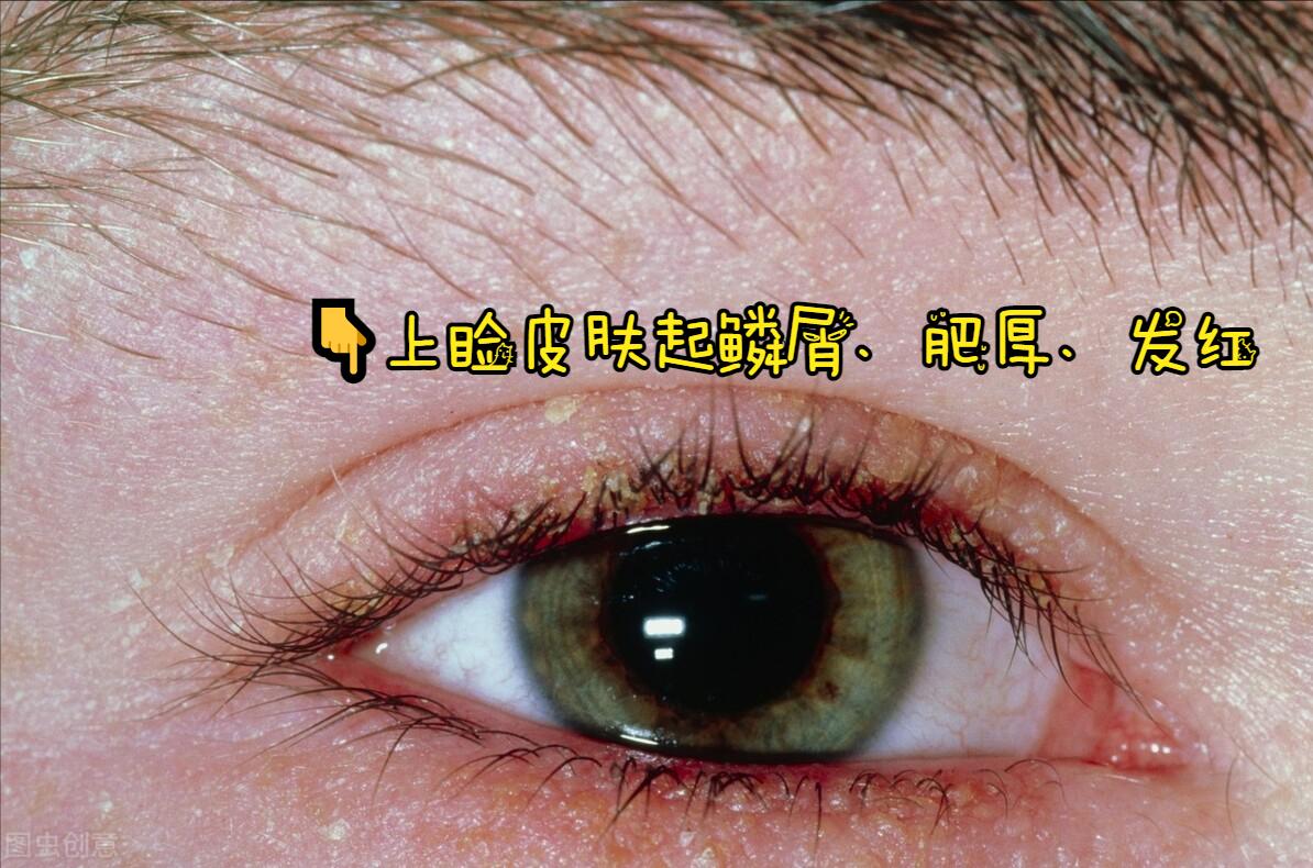 眼皮痒起皮屑皱巴巴是怎么回事,眼皮起皮屑还痒是怎么回事