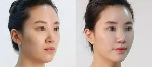 玻尿酸真的能永葆青春,明星都在用玻尿酸吗