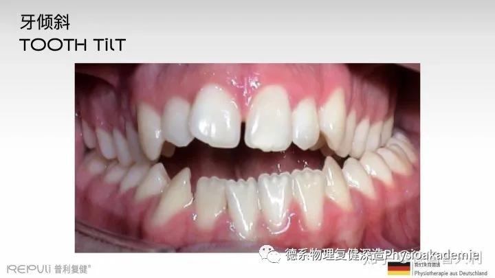 颞下颌关节紊乱综合征,颞下颌关节紊乱主要检查什么项目