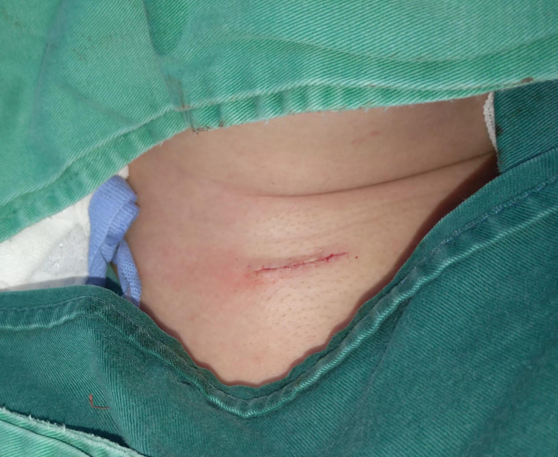 各种皮肤缝合伤口的方法对比