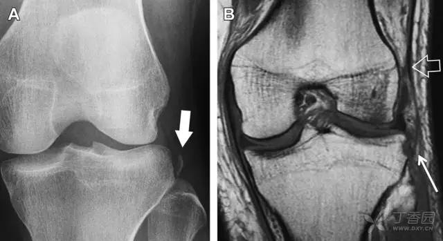 几种严重骨折医学名称,常见的骨折有哪些名称