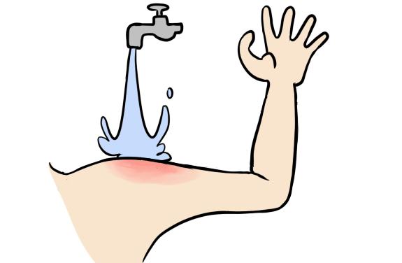 学点烧烫伤自救办法