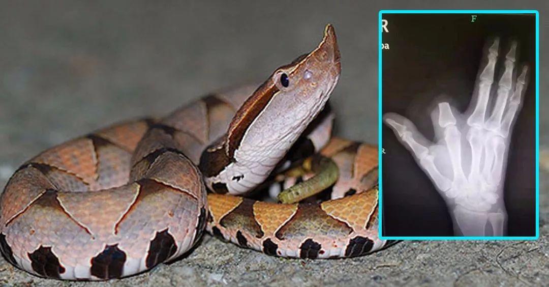 毒蛇咬伤截肢,毒蛇咬食指怎么处理