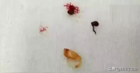 小孩长期不挖耳屎的危害,男童4年没有挖耳屎