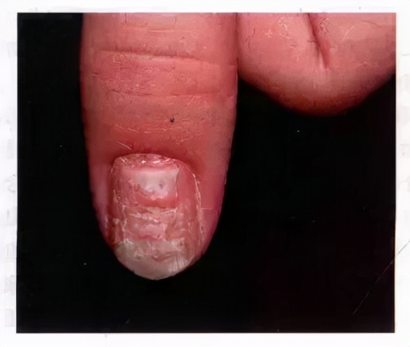 指甲有很小的黑色竖纹怎么回事,脚趾甲变黄变厚有竖纹是咋回事