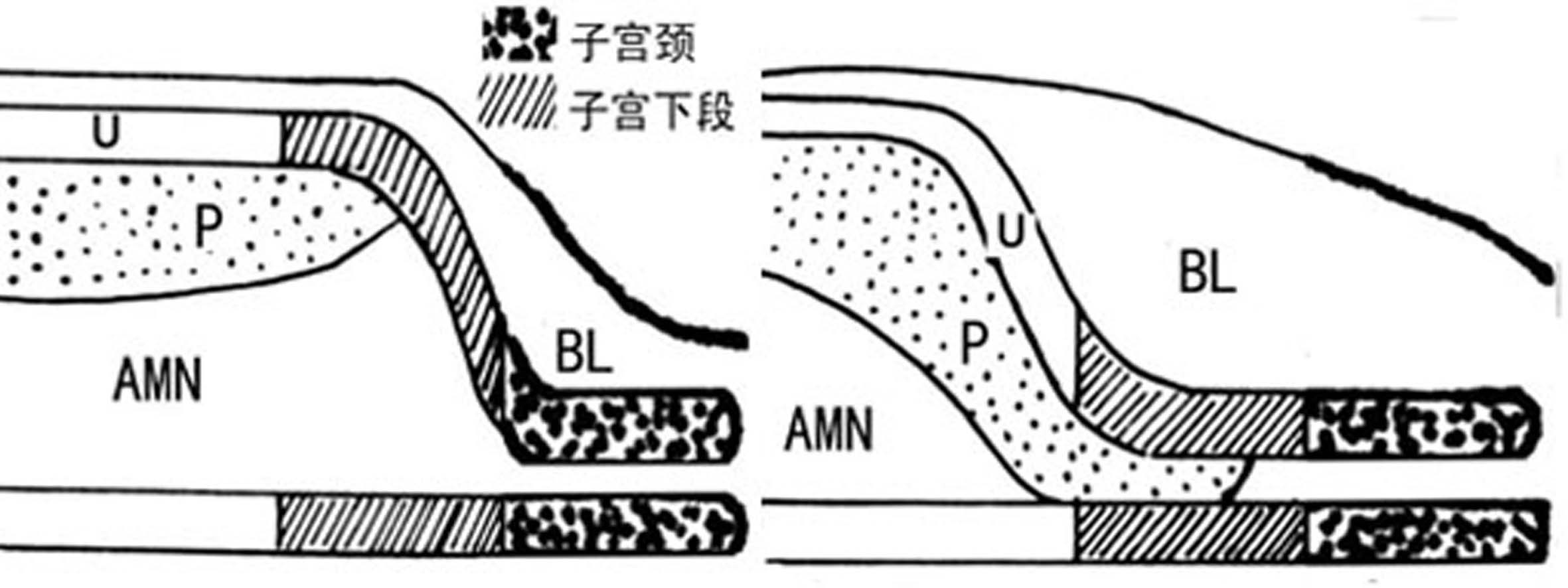 超声如何诊断前置胎盘,前置胎盘核磁报告显示胎盘无异常