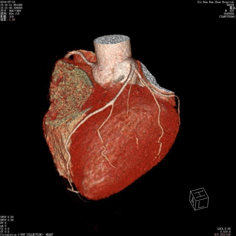肺部ct检查一般都能发现什么问题,肺部检查应该拍片还是应该做肺ct