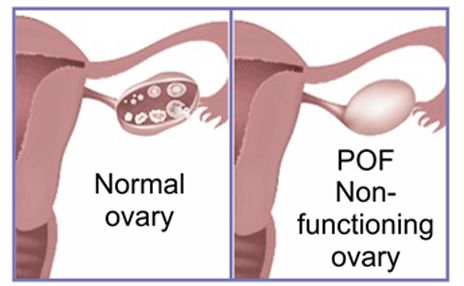 早发性卵巢功能不全的病因,早发性卵巢功能不全的治疗方法