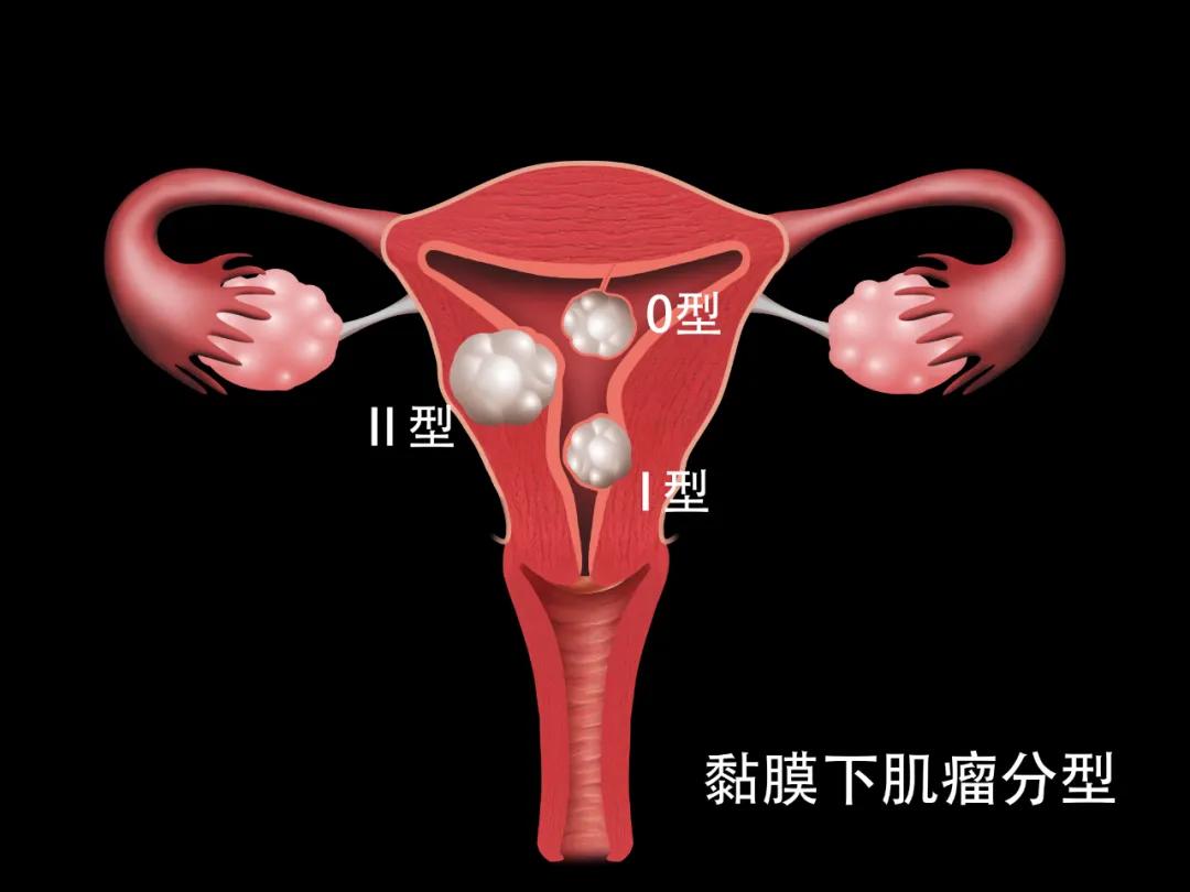 怀孕了子宫肌瘤会影响胎儿吗,子宫肌瘤在肌层内影响怀孕吗