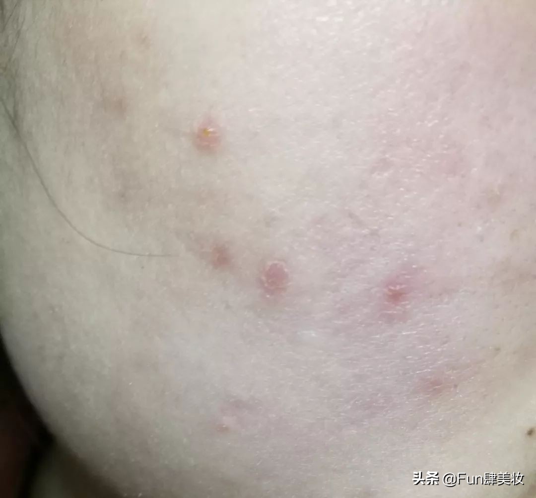 红痘印和红痘痘怎么祛,祛痘疤痘印痘坑最有效的方法