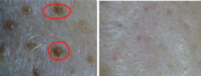 有黑头和没黑头有什么区别,没有长过黑头却长黑头怎么办