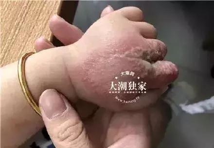 夏季孩子必须注意的虫子,夏天宝宝一定要小心蜱虫