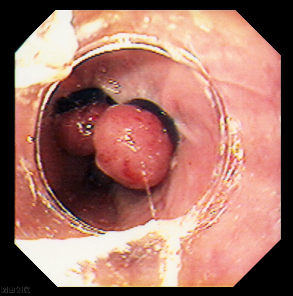 癌细胞最怕你做这6件事，要打败癌症，每天坚持！胜利终将属于你