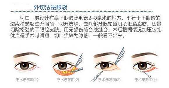 如何消除眼袋,如何消除眼袋泪沟的方法