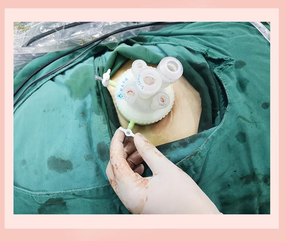 单孔手术优点,单孔手术的效果